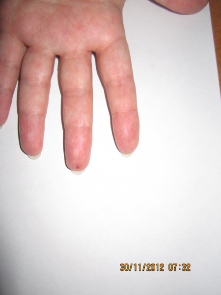 Особая точка на пальце